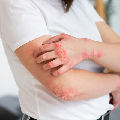 psoriasis